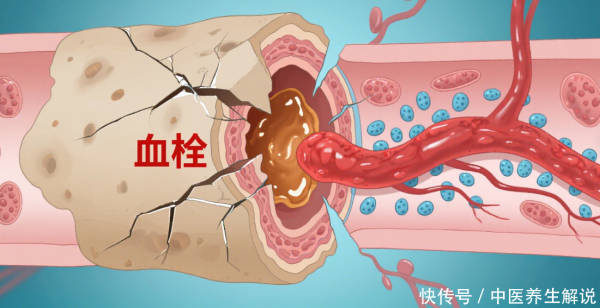 1号配资 装上心脏支架后，还能活多少年？医生：主要取决于这3点才是关键